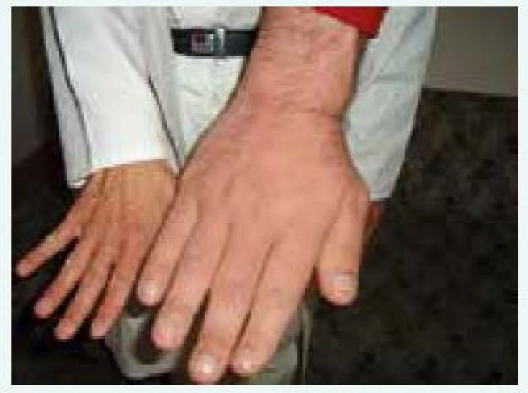 Vzhled ruky pacienta s gigantoakromegalií v porovnání s rukou normální (z archivu autora)