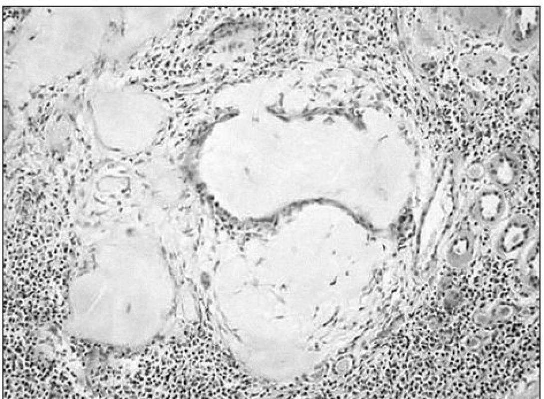 Vo svetelnej mikroskopii dominovali rozsiahle tubulárne nahromadenia homogénneho eozinofilného, PAS pozitívneho materiálu, hustý lymfocyto- plazmocytový infiltrát, atrofia tubulov so zhrubnutými, eozinofilnými homogénnymi stenami.