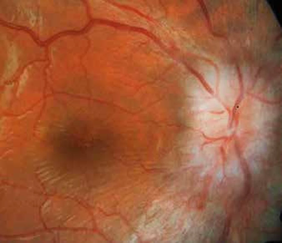Oftalmoskopický obraz edému terče zrakového nervu provázejícím idiopatickou intrakraniální hypertenzi na pravém oku. Na obrázku v pravé části je patrné neostré ohraničení terče vystupujícího nad úroveň sítnice (na obrázku narůžovělá okrouhlá ploška setřelého okraje, z níž centrálně vystupují cévní kmeny) typicky charakterizující edém papily zrakového nervu. Zobrazené cévy jsou zastřené a mají nepravidelný, místy až smazaný průběh. V zachycené centrální části sítnice je vlevo na obrázku tmavší ohraničená zóna (žlutá skvrna).