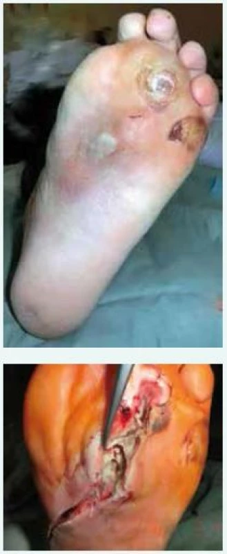 Hluboká infekce u syndromu diabetické nohy – před ošetřením (a) a po discizi planty (b)