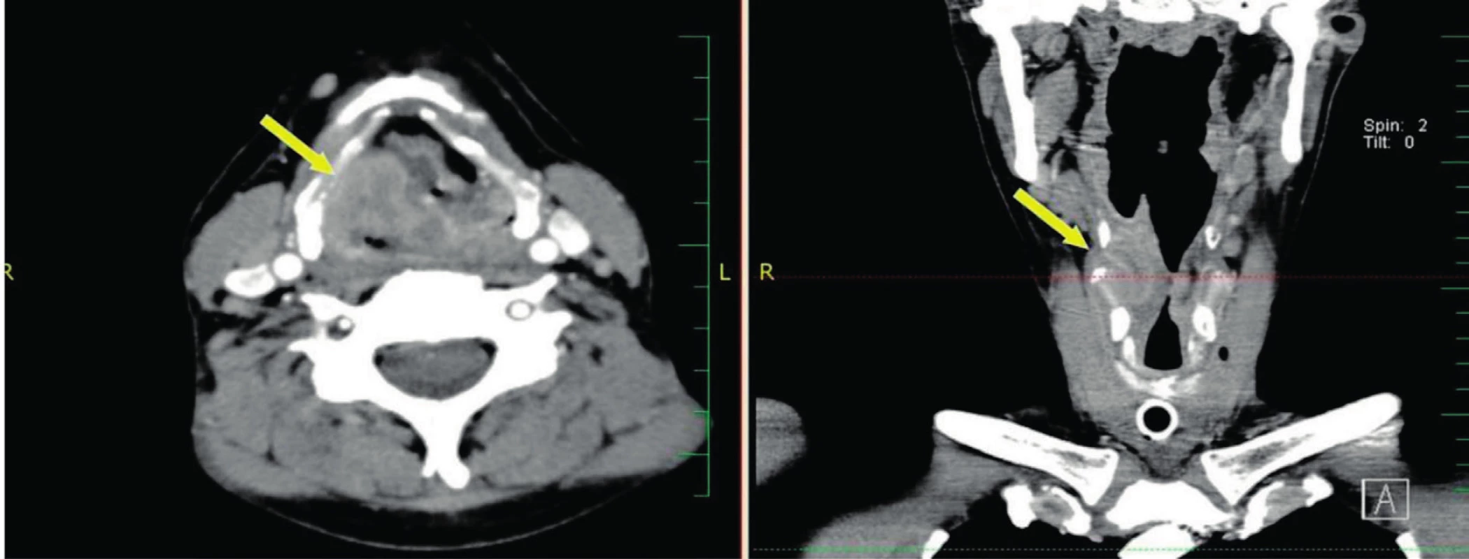 CT snímky s kontrastem - šipka ukazuje na supraglotický karcinom stadia T4 nevhodného pro TORS.