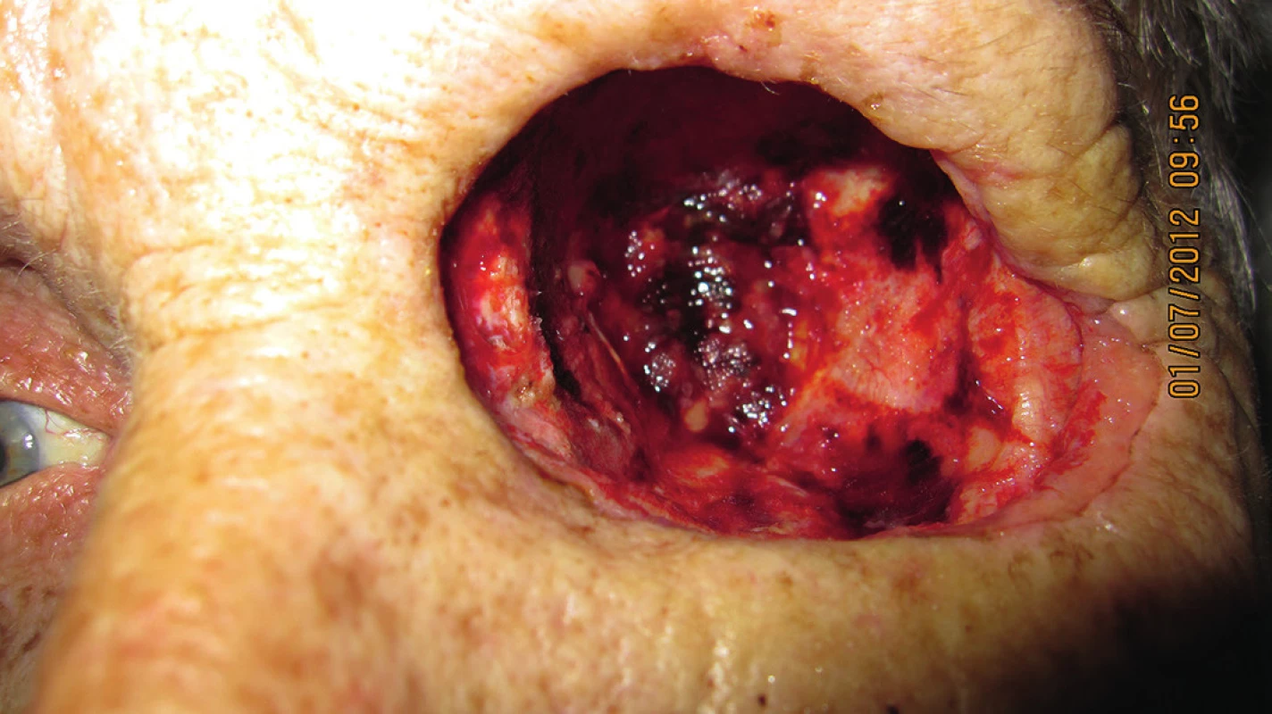Dutina očnice 1 mesiac po exenterácii (7/2012)