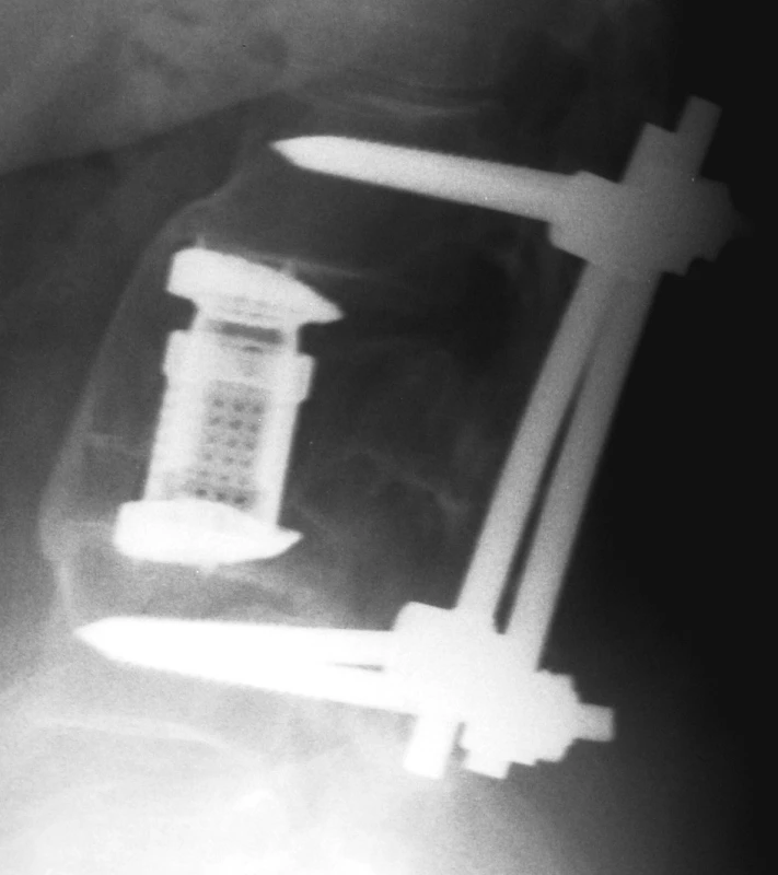 Vhojený koš Synex, přední intersomatická fúze
Pic. 5. Healed-in Synex cage, anterior intersomatic fusion