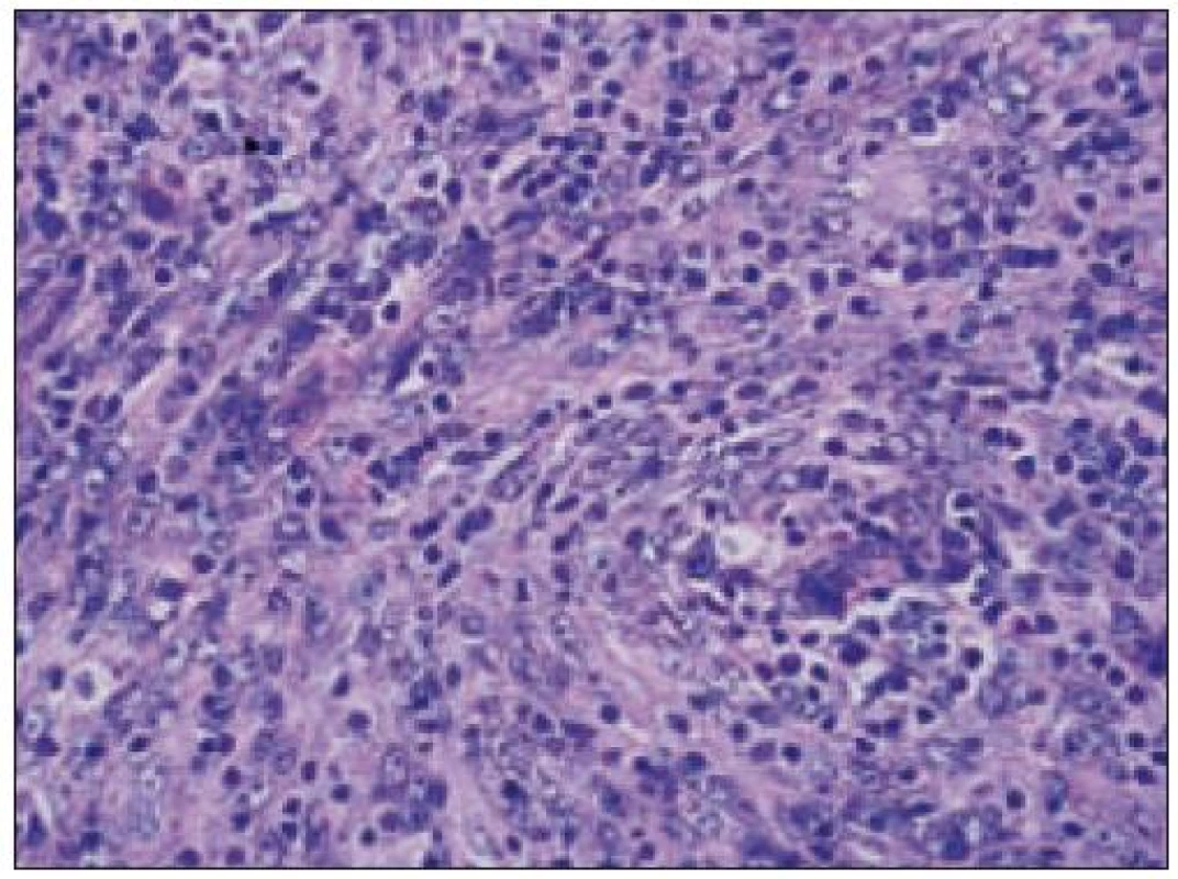 Sarkóm folikulových dendritických buniek (Giemsa, 40krát).