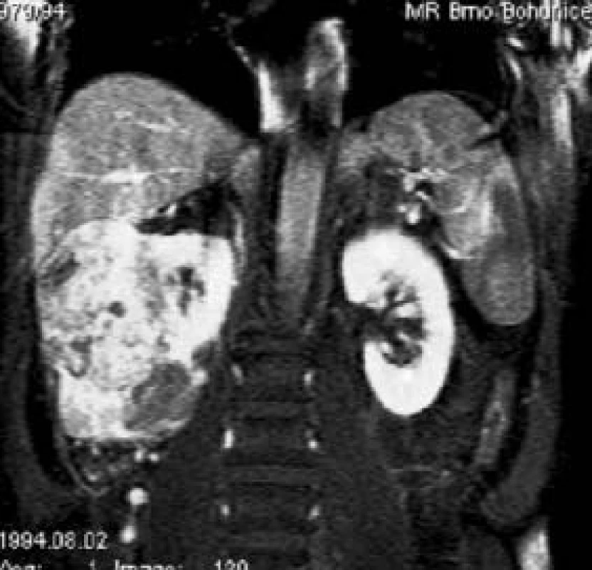 Grawitzův tumor pravé ledviny v koronárním obraze se saturací tukové tkáně po intravenózní aplikaci paramagnetické kontrastní látky.