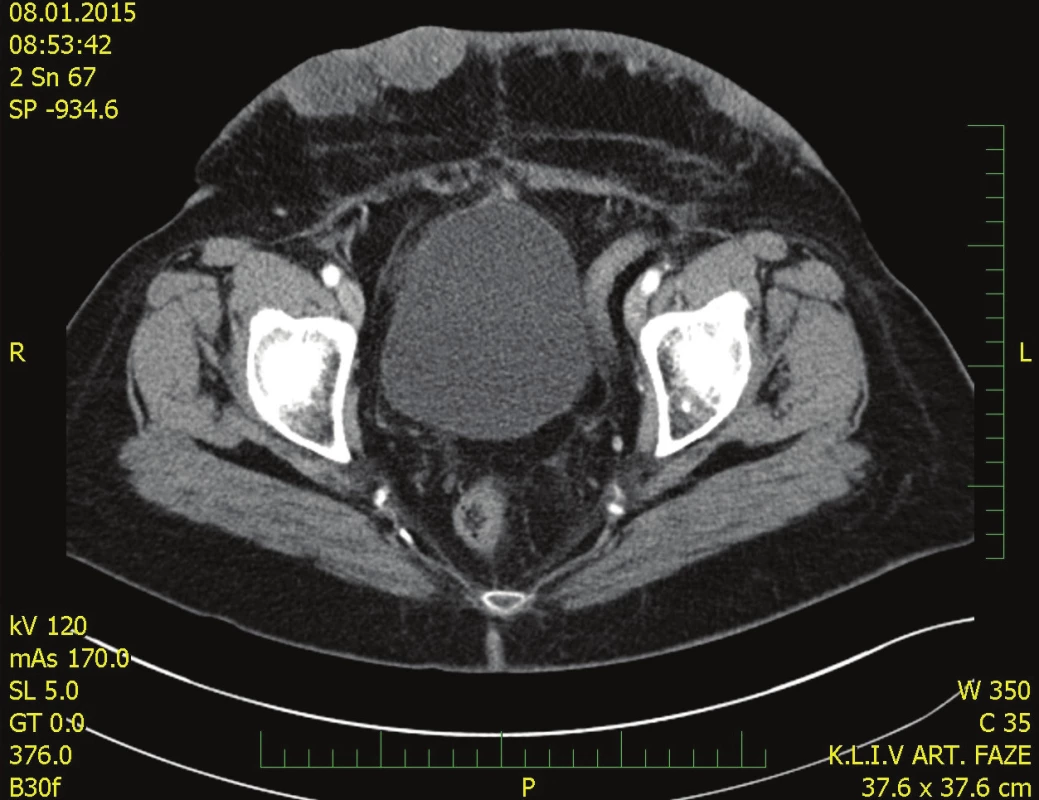 Předoperační CT břicha
Fig. 1. Preoperative CT scan of the abdomen