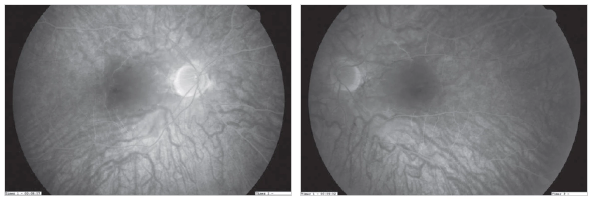 Fluorescenčná angiografia – oklúzia arteria centralis retinae bilateralis, cieva je bez perfúzie aj po 10 minúte
Fig. 2: Fluorescence angiography – bilateral central retinal artery occlusion; perfusion loss of the vessels even after 10 minutes