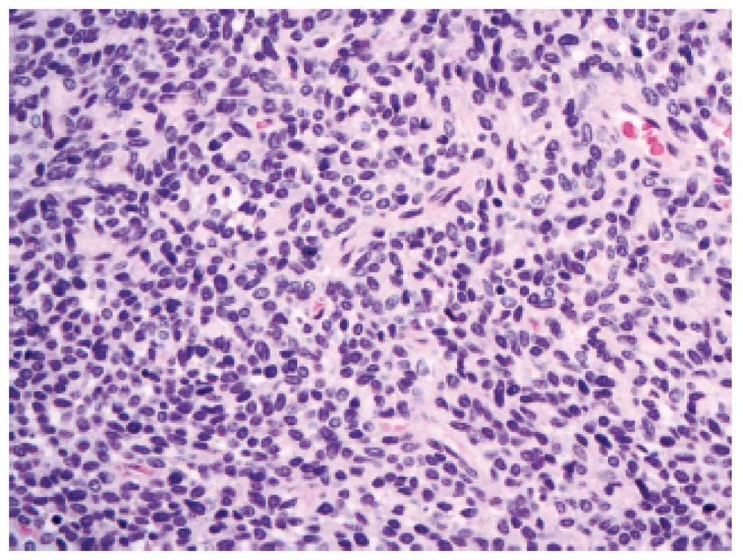 Solitární fibrózní tumor/hemangiopericytom mozkových plen, grade II (HE, 400x).