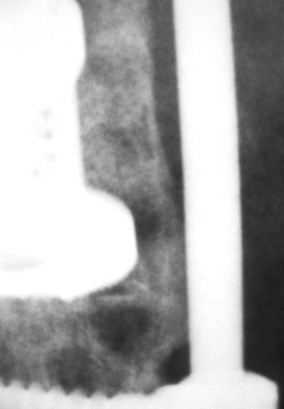 Intersomatická fúze, detail
Pic. 6. Intersomatic fusion, a detailed view