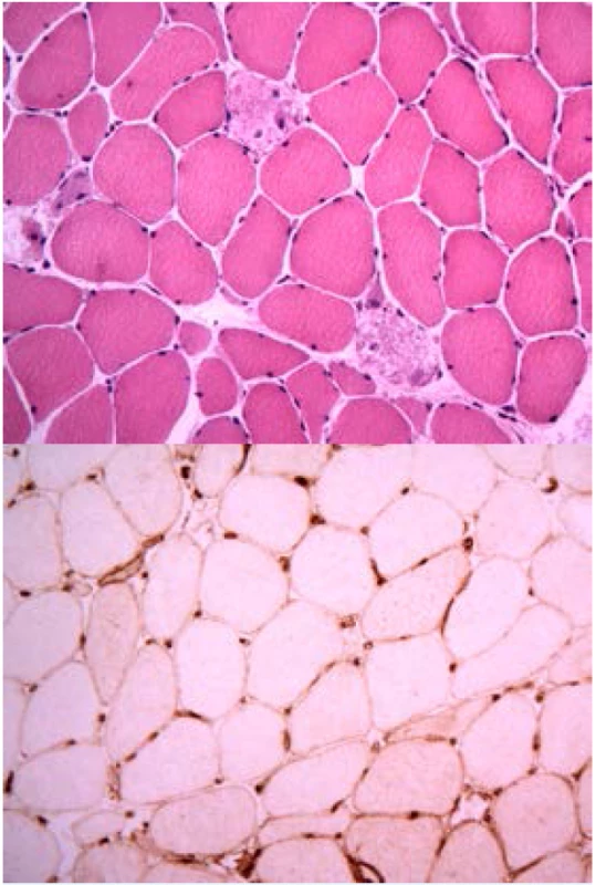 Histologický nález u imunitně zprostředkované nekrotizující myopatie a anti-HMGCR protilátkami:
a) nekrotická svalová vlákna bez zánětlivé infiltrace makrofágy (barvení hematoxylin a eozin),
b) hyperexprese molekul HLA I na povrchu svalových vláken u IMNM.
