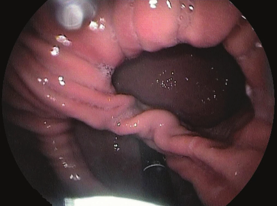„Double ring“ fenomén při endoskopii
Fig. 12: “Double ring phenomenon“ during endoscopy