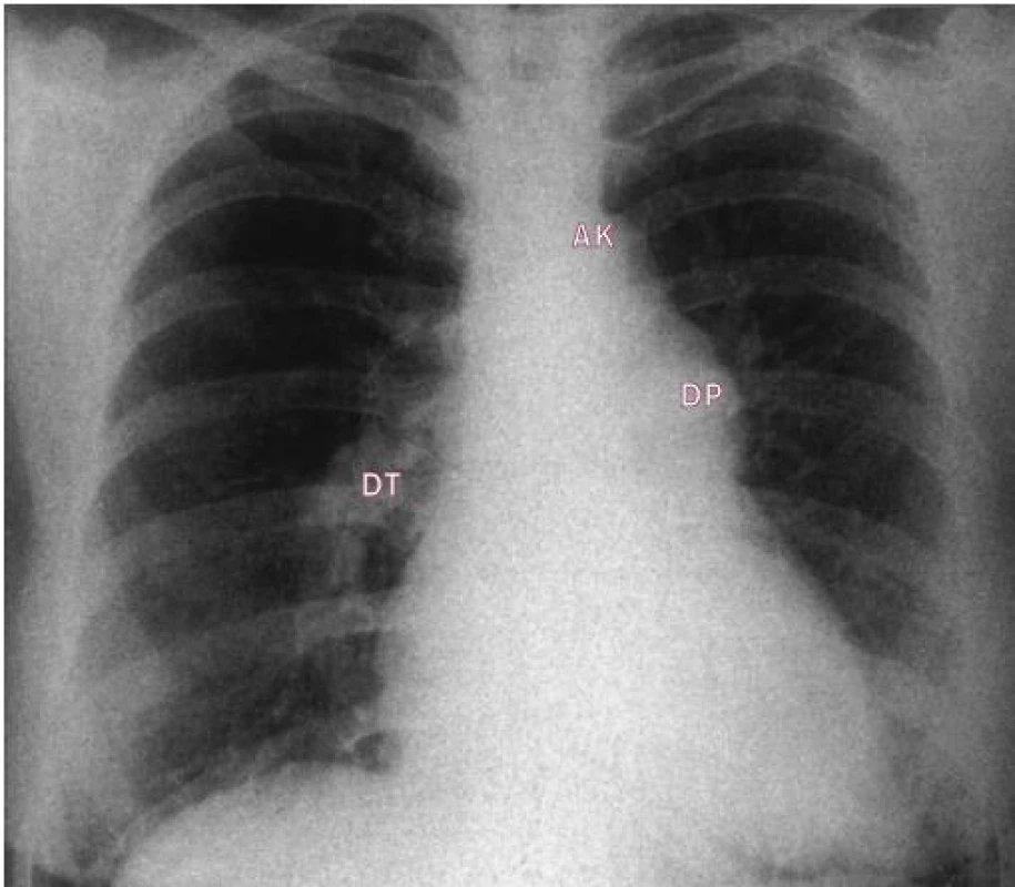 Skiagram dučeje s Eisenmengerovou reakcí ukazuje lehce rozšířené srdce, rozšířený kmen plicnice, prominující aortální knoflík. Hilové tepny jsou dilatované, periferní cévy normální.