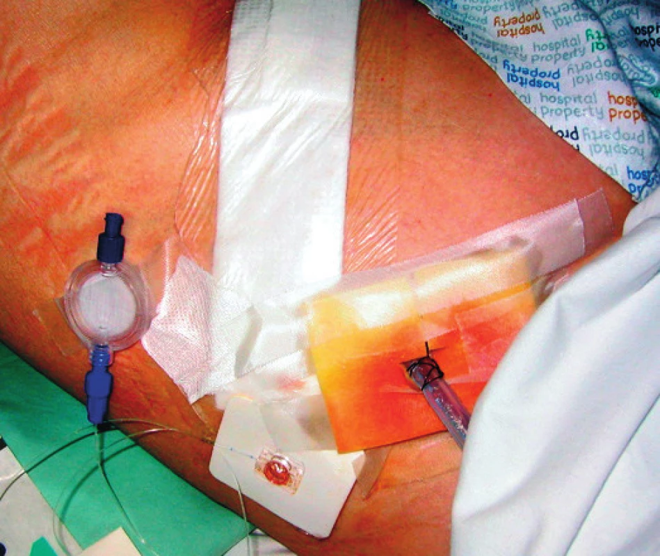 Fixovaný subkostální TAP katétr pro pooperační analgezii