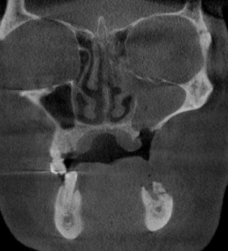 CB CT pacienta z obr. 2, 3, koronární řez – patrná oroantrální komunikace vlevo se slizničními hyperplaziemi vyplňujícími celou čelistní dutinu při chronické maxilární sinusitidě. V dolní čelisti vlevo je pak patrná nezhojená extrakční rána 34 se sekvestrací kosti a kostní sklerózou.