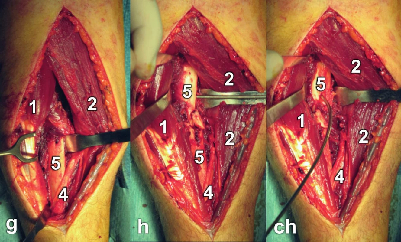 Henryho přístup: a – linie kožního řezu, b – preparace v podkoží, šipka ukazuje n. cutaneus antebrachii lat., c – stav po protětí fascie; d – identifikace m. brachioradialis, e – preparace v intervalu mezi m. brachioradialis a m. flexor carpi radialis, f – identifikace m. pronator teres; 
g – preparace distálního úlomku radia s úponem m. pronator teres; h – preparace proximálního úlomku; ch – supinace proximálního úlomku pomocí K-drátu: 1 – m. brachioradialis, 2 – m. flexor carpi radialis, 3 – a. radialis, 4 – šlacha m. pronator teres, 5 – radius.
Fig. 9: Henry approach: a – skin incision line, b – subcutaneous dissection, the arrow indicates lateral cutaneous nerve of forearm, c – split fascia; d – identification of brachioradialis, e – dissection in the interval between brachioradialis and flexor carpi radialis, f – identification of pronator teres; g – dissection of the distal fragment of radius with insertion of pronator teres; h – dissection of the proximal fragment; ch – supination of the proximal fragment by K-wire: 1 – brachioradialis, 2 – flexor carpi radialis, 3 – radial artery, 4 – pronator teres tendon, 5 – radius.