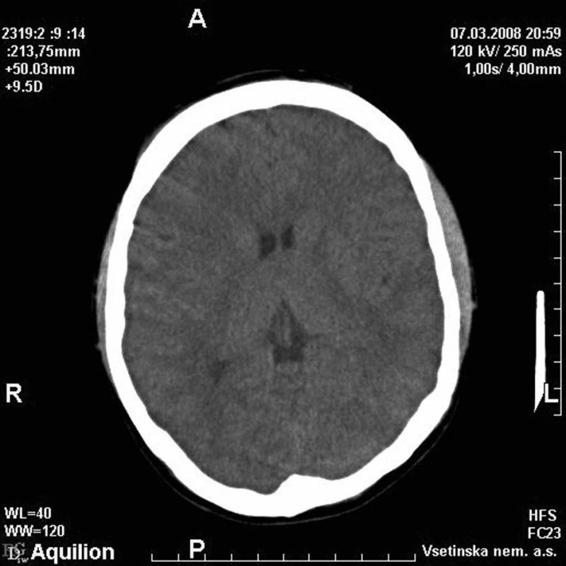 Nativní CT mozku brzy po úrazu 
Fig. 1. Early posttraumatic native brain CT images