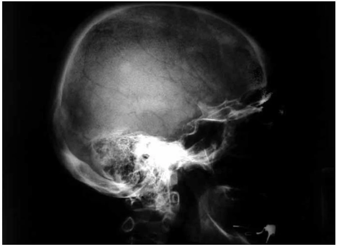 Boční rentgenový snímek lebky u pacientky s osteosklerotickým mnohočetným myelomem a POEMS syndromem s četnými osteosklerotickými ložisky na lebce.