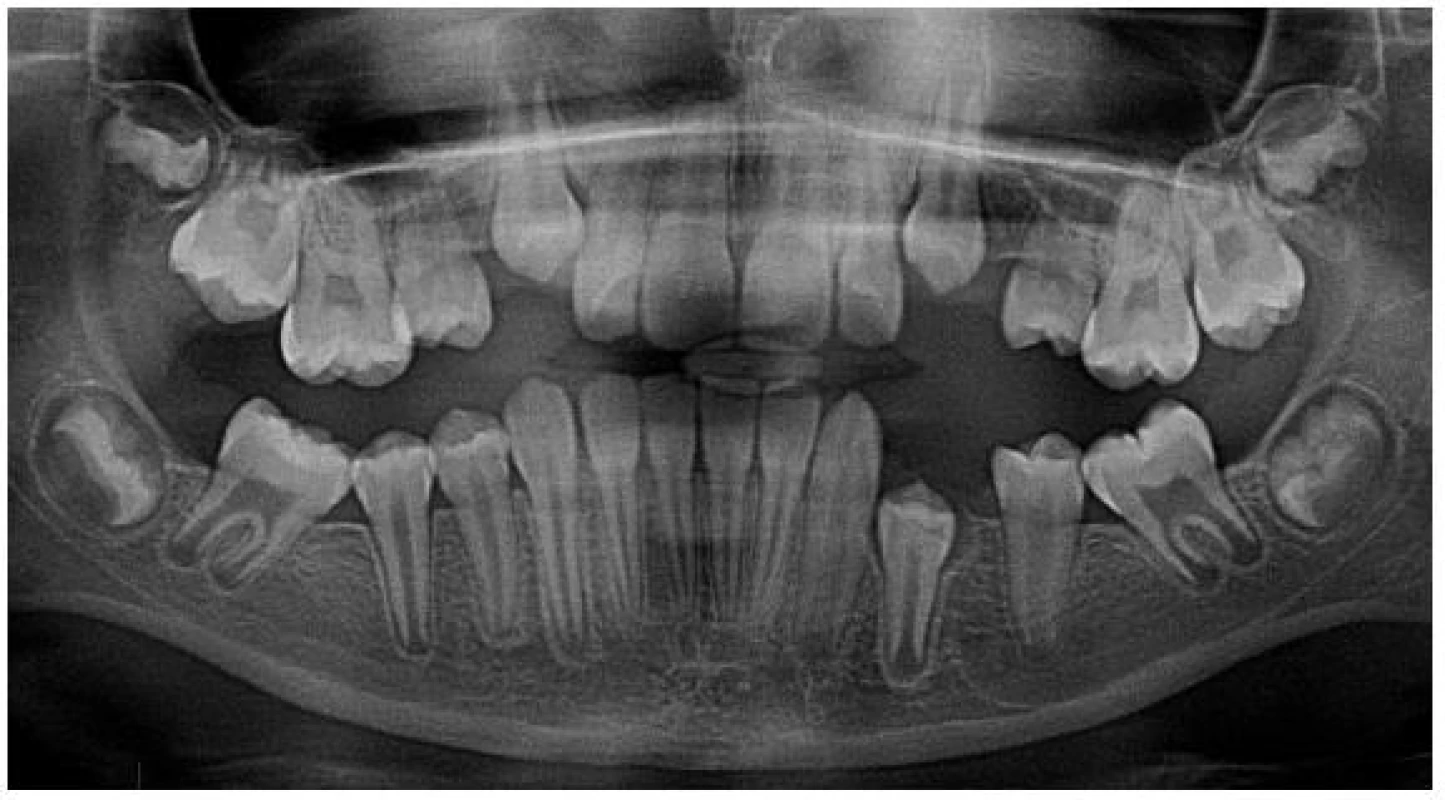 Ortopantomogram po spontánním meziálním posunu zubu 37 a 47