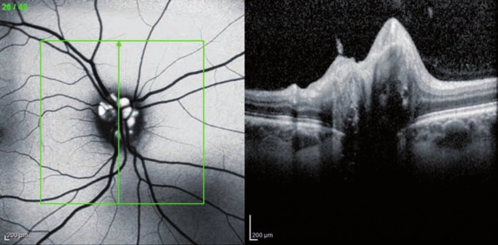 OCT Spectralis – fundus autoflorescencia a prierez TZN pravé oko (pacient č. 2). Drúzy sa zobrazujú autoflorescenciou, v pravej časti obrázka prierez TZN.