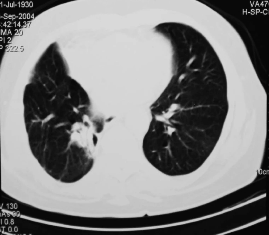 CT plic 3 měsíce po RFA ložiska v dolním plicním laloku vpravo
Fig. 4: Lung CT 3 months after RFA of the focus in the lower right lung lobe