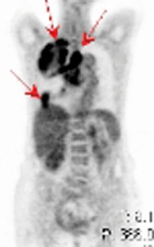 PET – ložiska hypermetabolizmu glukózy v medi astinu, horním laloku pravé plíce, drobnější ložisko nasedající na pravo u polovinu bránice u pacienta se špatně diferencovaným sarkomem.