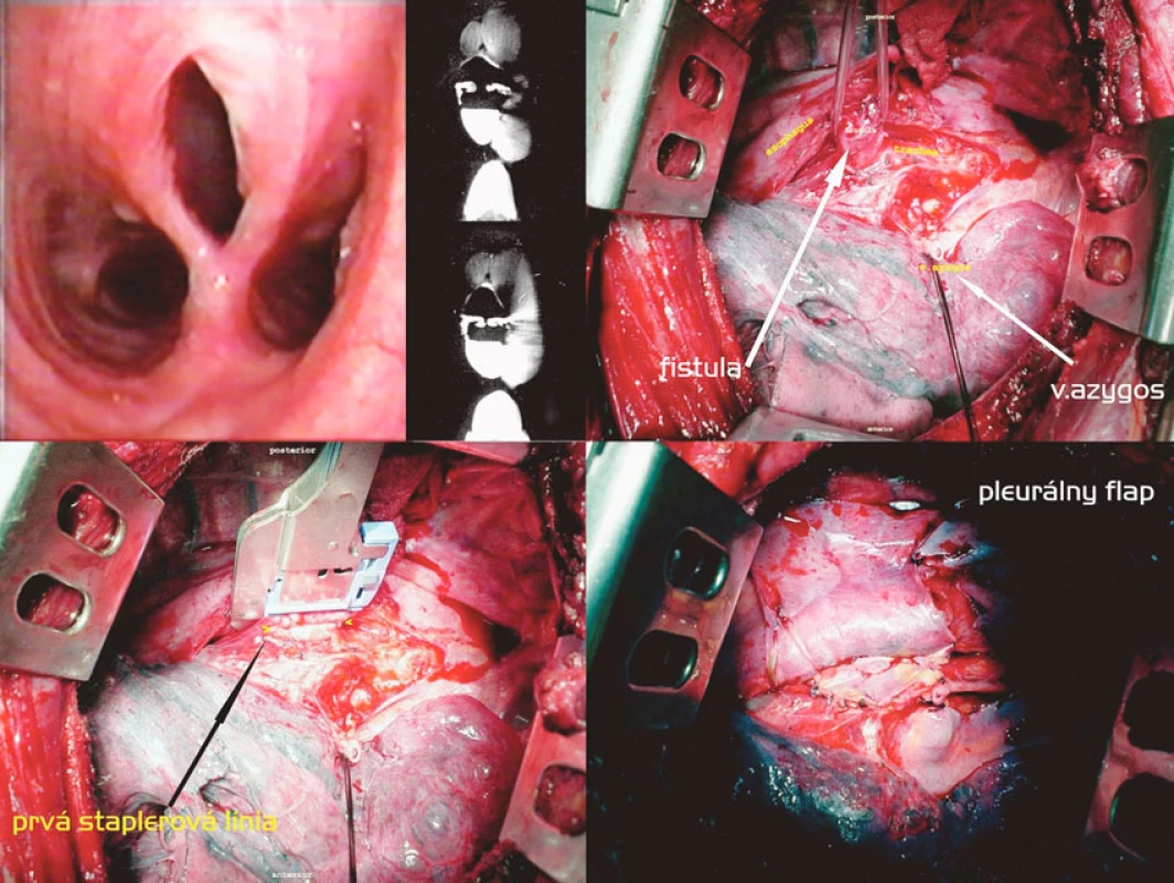 Staplerová separácia fistuly, pleurálny flap cestou pravostrannej torakotómie. Postup zľava doprava, zhora nadol: Tracheoskopický a CT obraz fistuly. Vypreparovaná fistula, prerušená v. azygos. Naloženie druhého pravouhlého staplera. Pleurálny flap vmedzerený medzi sutúry
Fig. 4. Stapler separation of the fistule, pleural flap via right-sided thoracotomy. Left to right and top to down: tracheoscopic and CT views of the fistule. A fistula isolated, the azygos vein divided. Application of another right angle stapler. A pleural flap is placed between the sutures