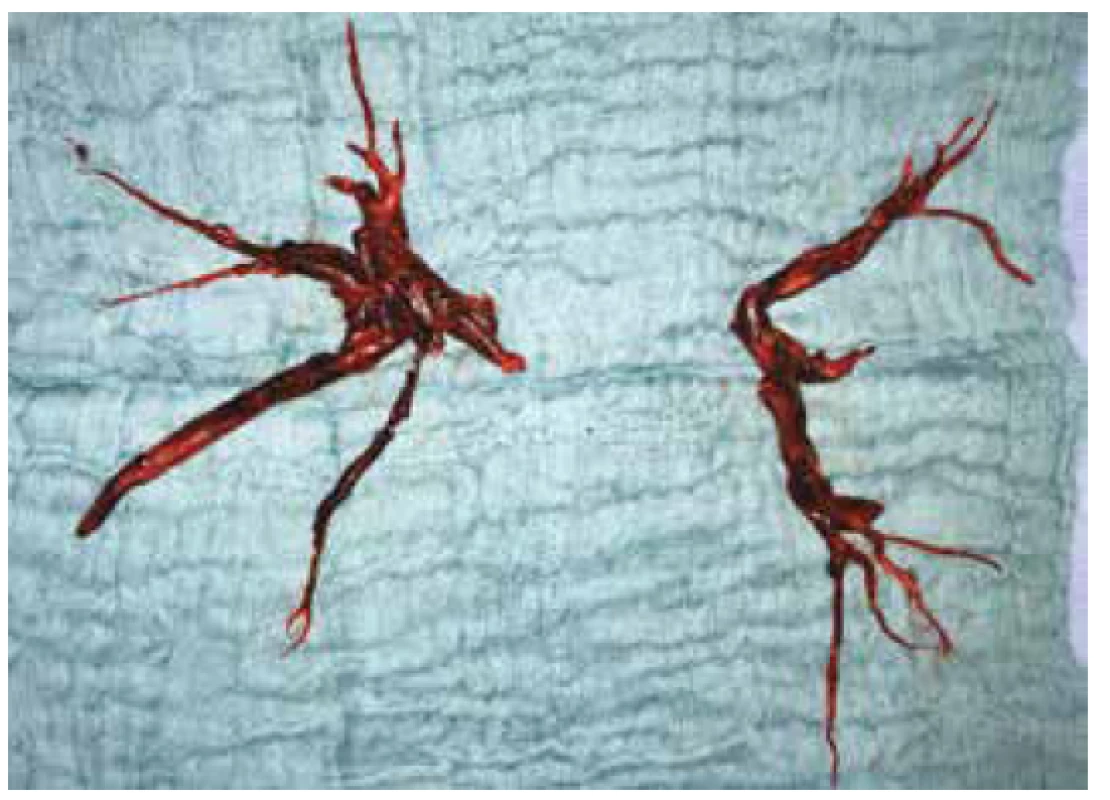 Embolus odstraněný z levé a pravé větve plicnice<br>
Fig. 3: Emboli extracted from the left and right pulmonary
artery