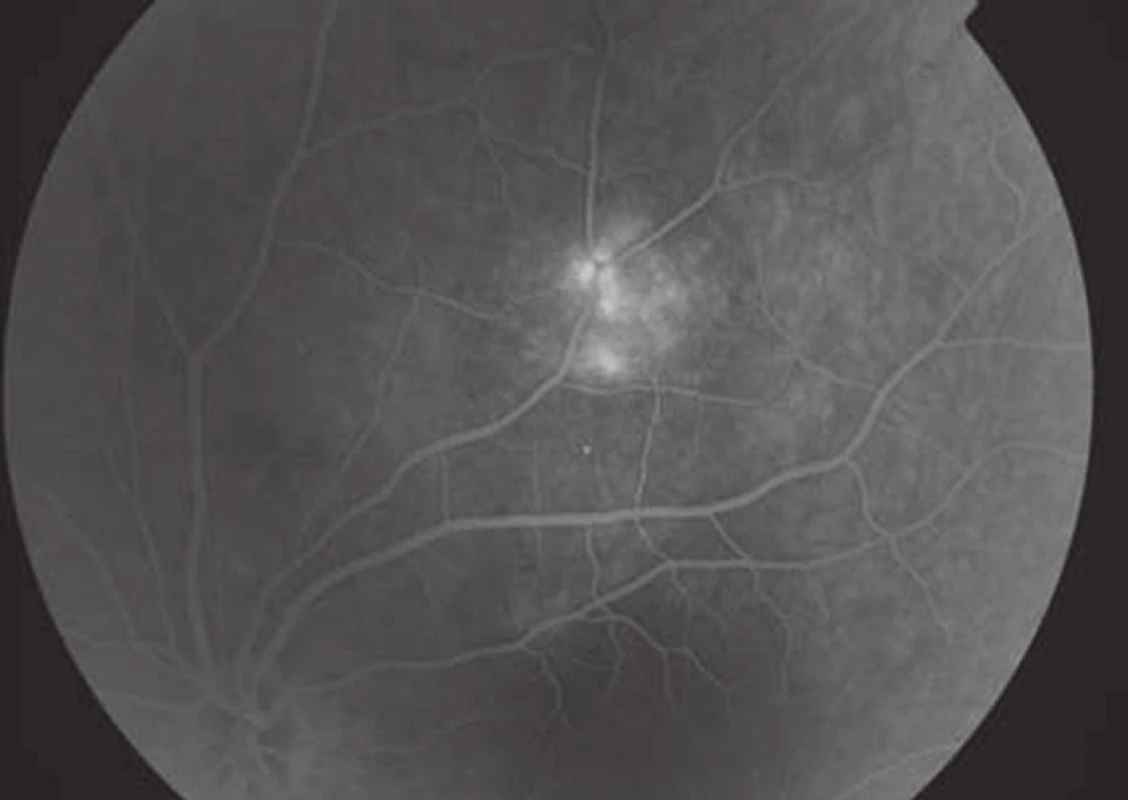Nález na fundu levého oka na fluorescenční angiografii – horní temporální oblast