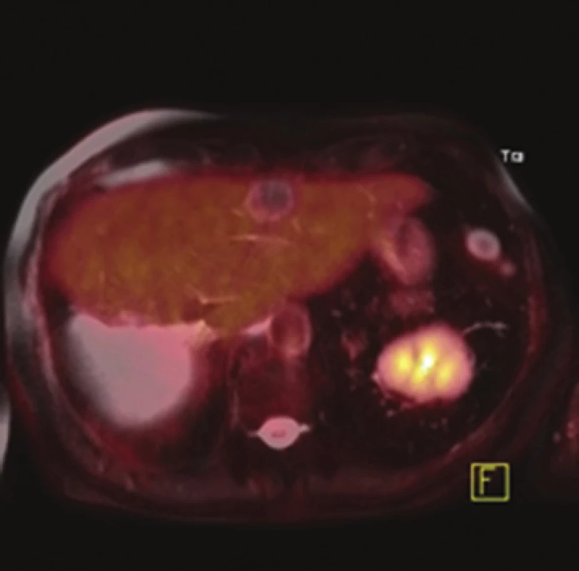 PET/MR obraz jater po RFA – bez známek recidivy v oblasti zbytkového parenchymu (axiální řez)
Fig. 5: PET/MRI hybrid scan after RFA – no signs of recurrence in the residual parenchyma of the liver (axial view)