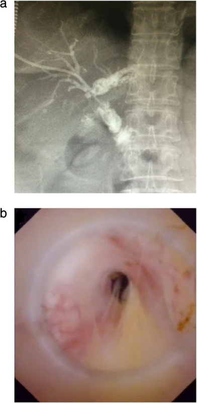 Anastomotic strictures after Roux-en-Y hepaticojejunostomy: a) Percutaneous transhepatic cholangiography showed the dilatation of the left hepatic duct and anastomotic stricture. b) A narrow opening of bile duct can be seen under choledochoscope
