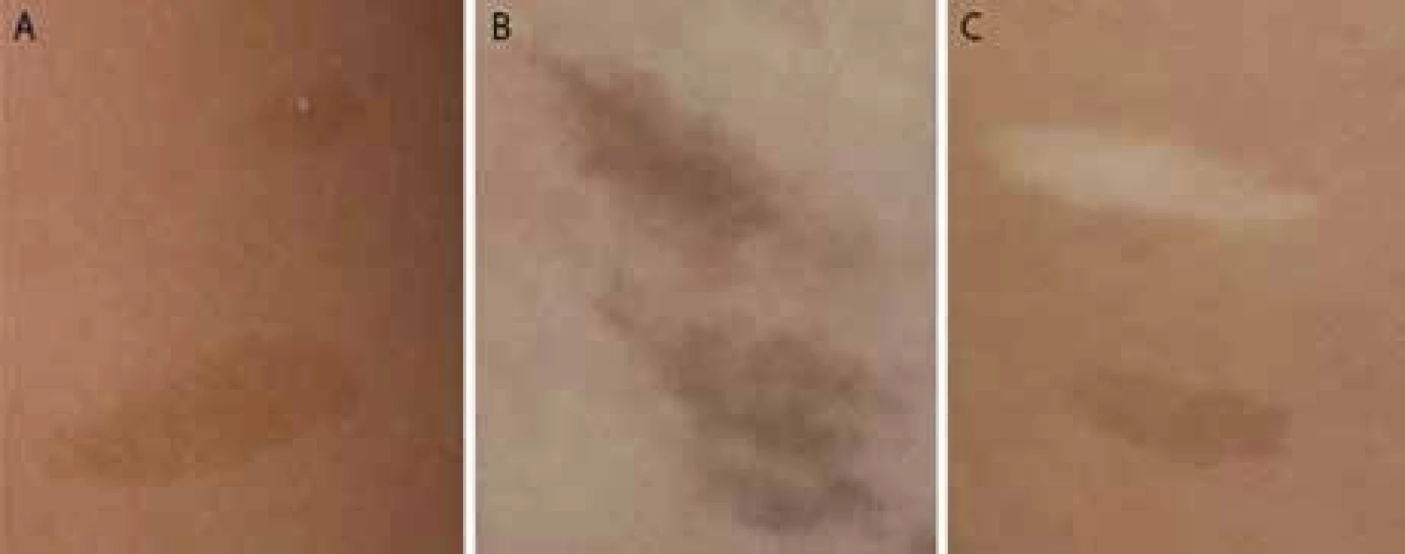 A. Pravidelné okraje a pravidelne rozložená pigmentácia u dieťaťa s NF1; 1B. Hyperpigmentácie s difúznymi okrajmi a nepravidelnou pigmentáciou u dieťaťa s CMMR-D syndrómom; 1C. Hyper- a hypopigmentované kožné makuly u dieťaťa s CMMR-D syndrómom.