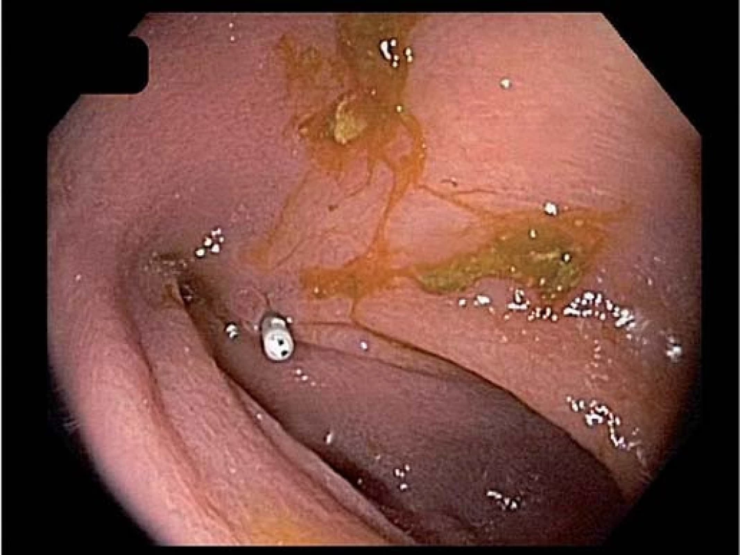 Ústí píštěle v tračníku označené klipem.
Fig. 3. The orifice of the fistula in the colon marked by a hemoclip.