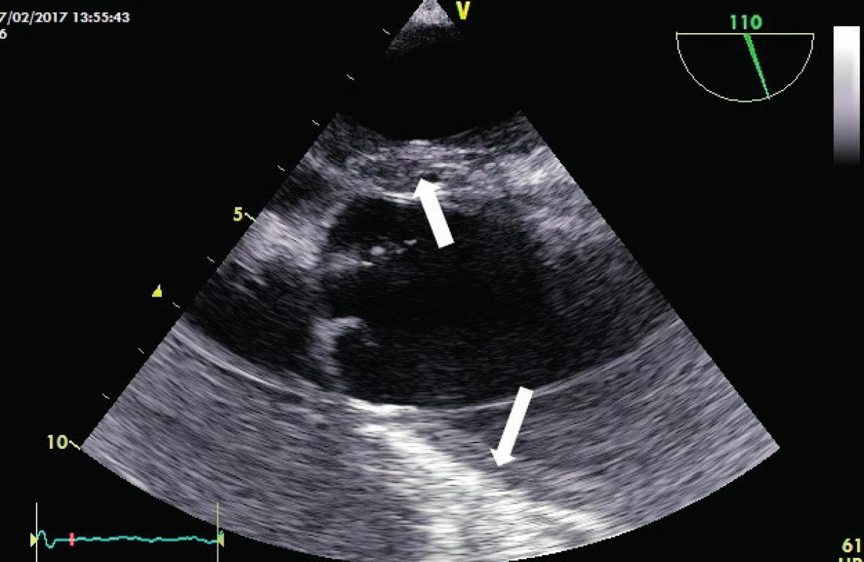 Intramurální hematom
TEE zobrazení aorty v dlouhé ose s hematomem ve stěně zasahujícím až ke kořeni aorty (bílé šipky).