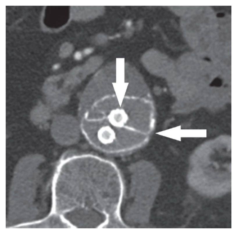 Příčný řez výdutí s implantovaným systémem Nellix
Fig. 2: Cross-section of the aneurysm with implanted Nellix system
