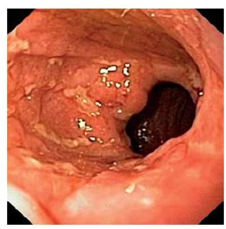 Zánět sliznice ponechané části anorekta (cuffu) pod pouchem (cuffitida).
Fig. 3. Inflammation of remnant anorectal cuff under pouch (cuffitis).