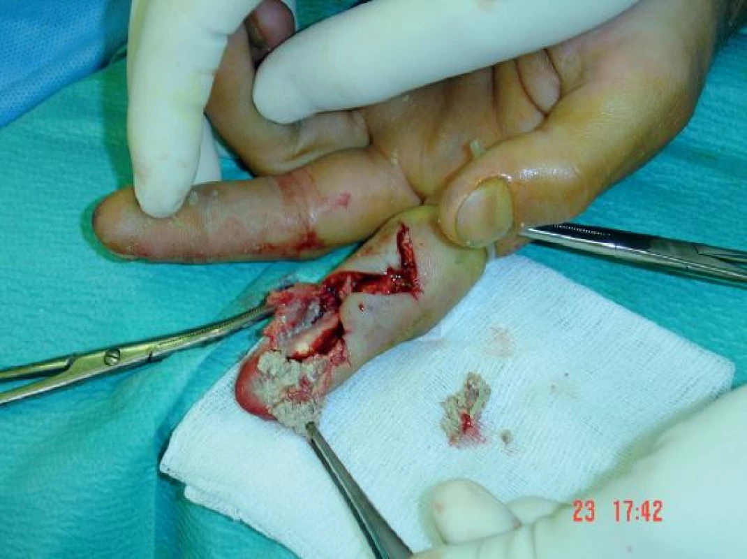 Peroperační snímek 2. prstu pravé ruky s cizí látkou v měkkých tkáních - detail