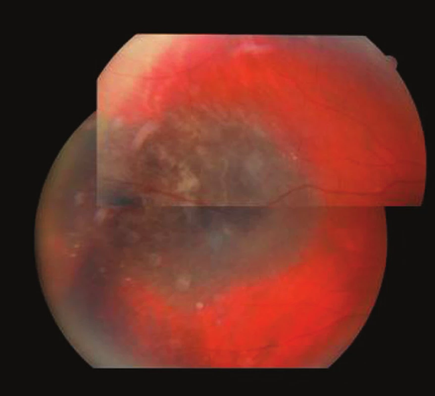 Pacient 1. Temporálne lokalizovaný MMCH s drúzami na periférii, pravé oko. Jeden rok po protónovej rádioterapii