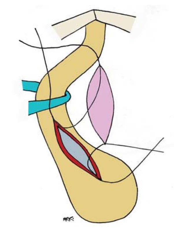 Proximální a distální apex, otevřené uretry jsou našity na hroty štěpu.