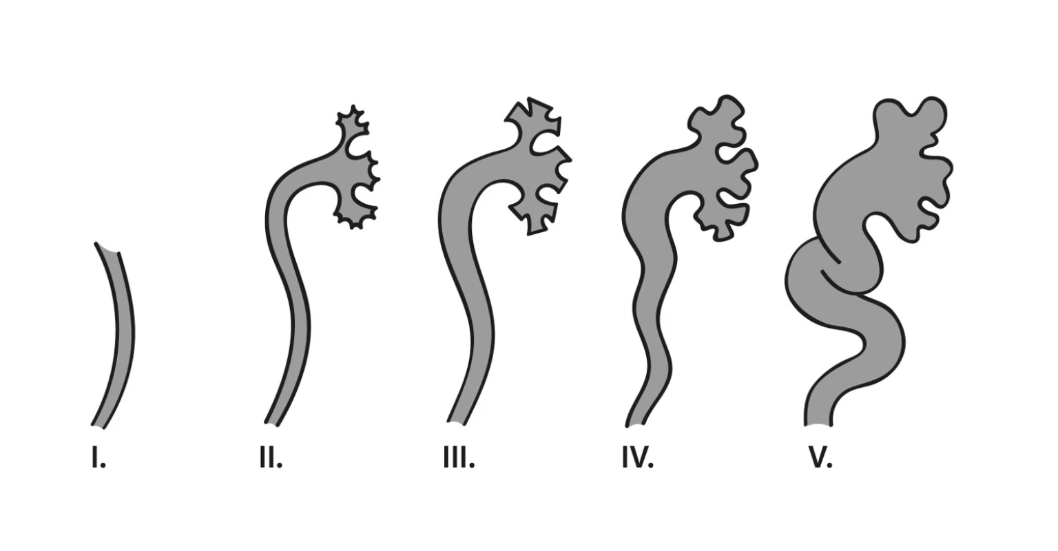 Klasifikace VUR dle závažnosti podle The International classification of vesicoureteral reflux (obrázek podle předlohy vytvořila MUDr. Lucie Gonsorčíková, Ph.D.) (1).