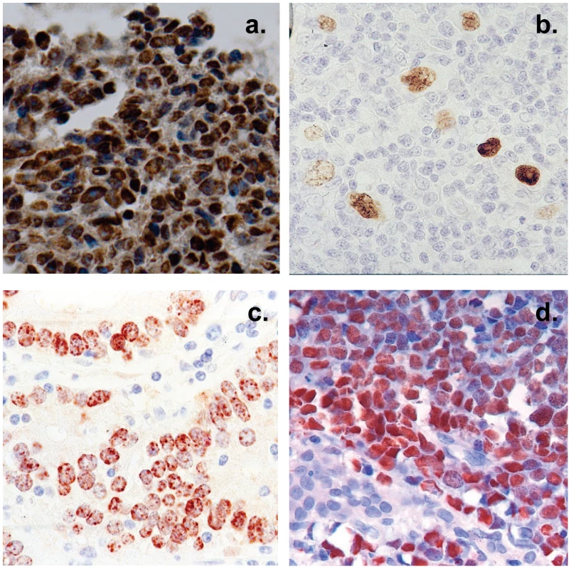 Histological cross sections of typical tumor biopsies used in this study stained for expression of EBV genes.