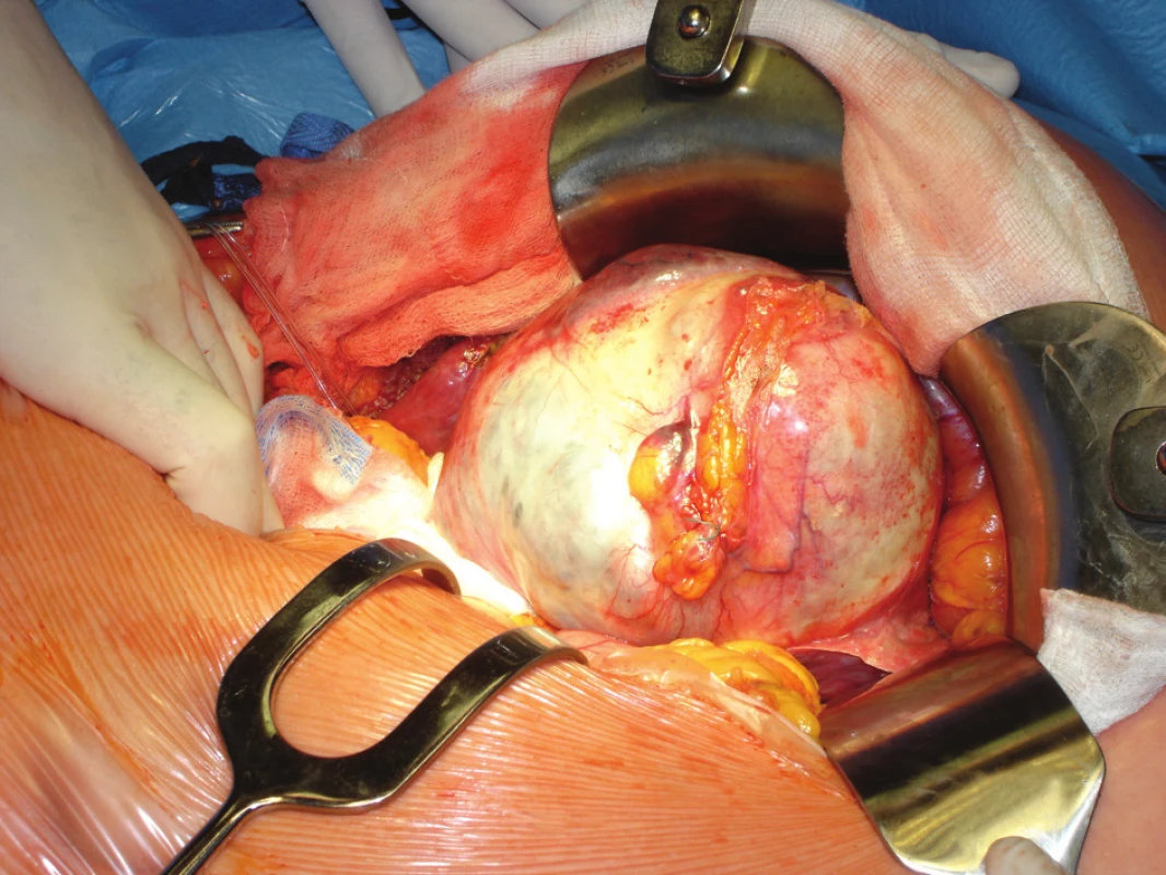 Peroperační snímek při resekci cystdenomu u případu 3 
Photo 2. Cystadenoma resection peroperative view – case No. 3