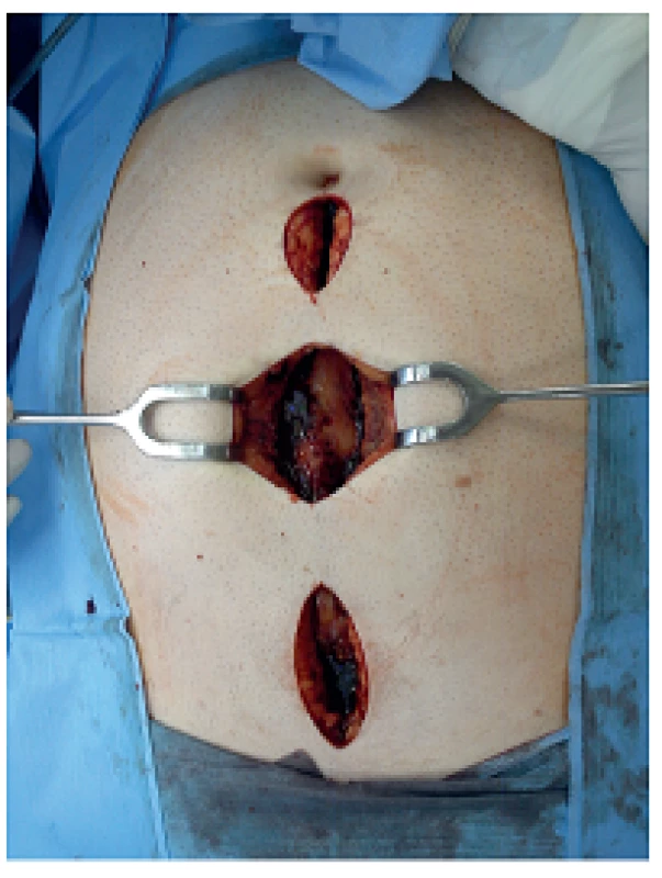 Fasciotomie v linea alba při intraabdominální hypertenzi
Fig. 5: Linea alba fasciotomy for abdominal compartment syndrome
