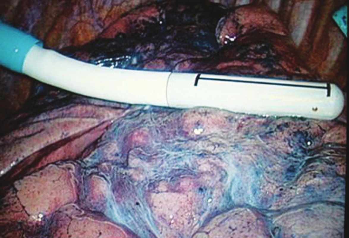 Peroperační ultrazvukové vyšetření plic endoskopickou sondou
Pic. 3. Peroprative ultrasonographic examination of the lungs by endoscopic probe