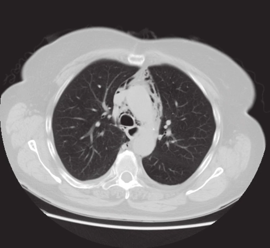 CT hrudníku v transverzální rovině: podél kontur aortálního oblouku, vena cava superior, trachey a jícnu jsou patrné mnohočetné a při v. azygos ojedinělé, nepravidelné hypodezity odpovídající vzduchovým bublinám při pneumomediastinu.
