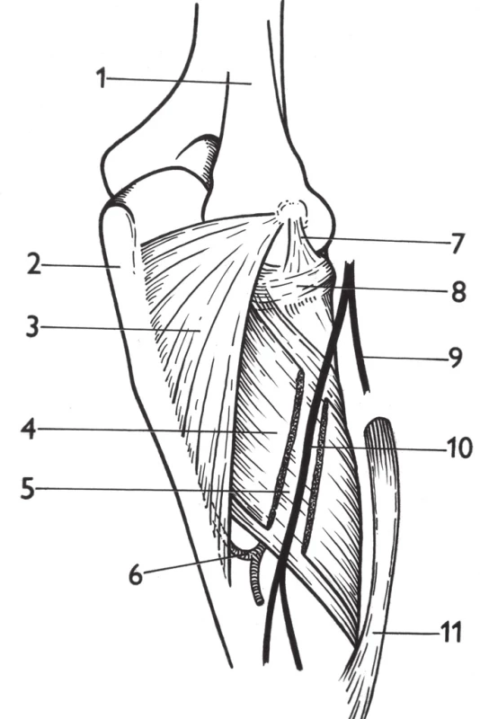 Canalis supinatorius: 1 – humerus, 2 – ulna, 3 – m. anconeus, 4 – povrchová vrstva m. supinator, 5 – hluboká vrstva m. supinator, 6 – a. interossea recurrens, 7 – lig. collaterale lat., 8 – lig. anulare radii, 9 – r. superficialis n. radialis, 10 – r. profundus n. radialis, 11 – m. pronator teres. &lt;i&gt;(Převzato z Bartoníček J. Operační přístupy u zlomenin hlavičky a diafýzy rádia. Acta Chir Orthop Traumatol Cech 1988;55:497–516.)&lt;/i&gt;
Fig. 6: Supinator channel: 1 – humerus, 2 – ulna, 3 – anconeus, 4 – superficial layer of the supinator, 5 – deep layer of the supinator, 6 – interosseous recurrent artery, 7 – lateral collateral ligament, 8 – radial annular ligament, 9 – superficial branch of the radial nerve, 10 – deep branch of the radial nerve, 11 – pronator teres. &lt;i&gt;(Reprinted from Bartoníček J. [Surgical approaches in fractures of the head and shaft of radius]. Acta Chir Orthop Traumatol Cech 1988;55:497–516.)&lt;/i&gt;