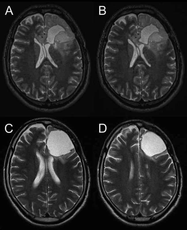 A, B) T2W MRI pacienta s gliomem F sin v době progrese objemu neenhancujícího LGG , bez suspektního up-grade dle MRS. C, D) T2W MRI po kombinované chemoradioterapii s dobrou reakcí a regresí T2 hyperintenzity.