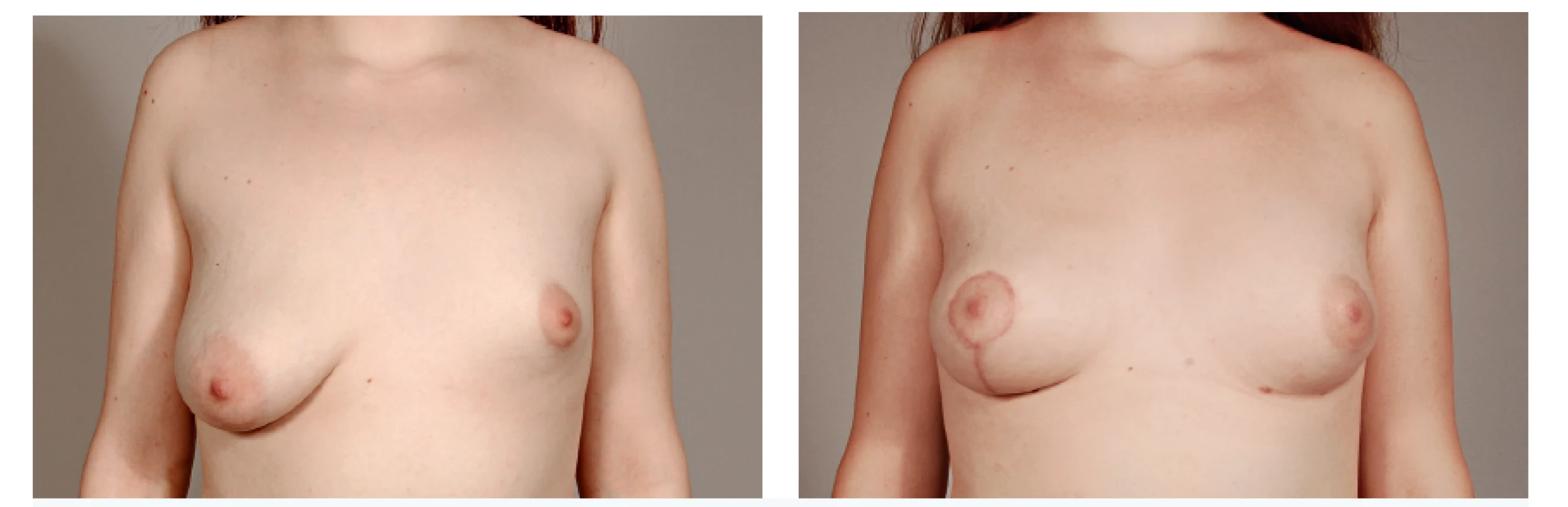 A 17-year-old patient with hypoplastic left breast and ptotic right breast before and after 2 sessions of lipomodelling on the left and contralateral vertical mastopexy with augmentation by fat grafting in décolleté area - 6 months follow-up