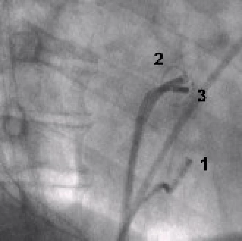 Rentgenový snímek srdce (RAO – pravá šikmá projekce).