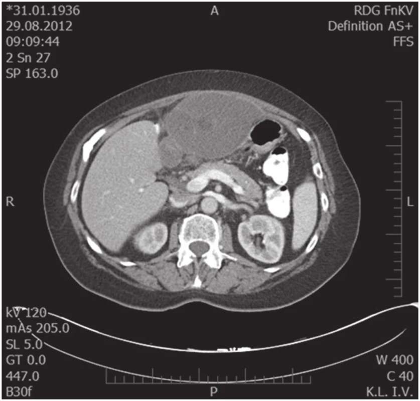 Předoperační MDCT scan, transverzální snímek
Fig. 3. Preoperative MDCT scan, transversal scan