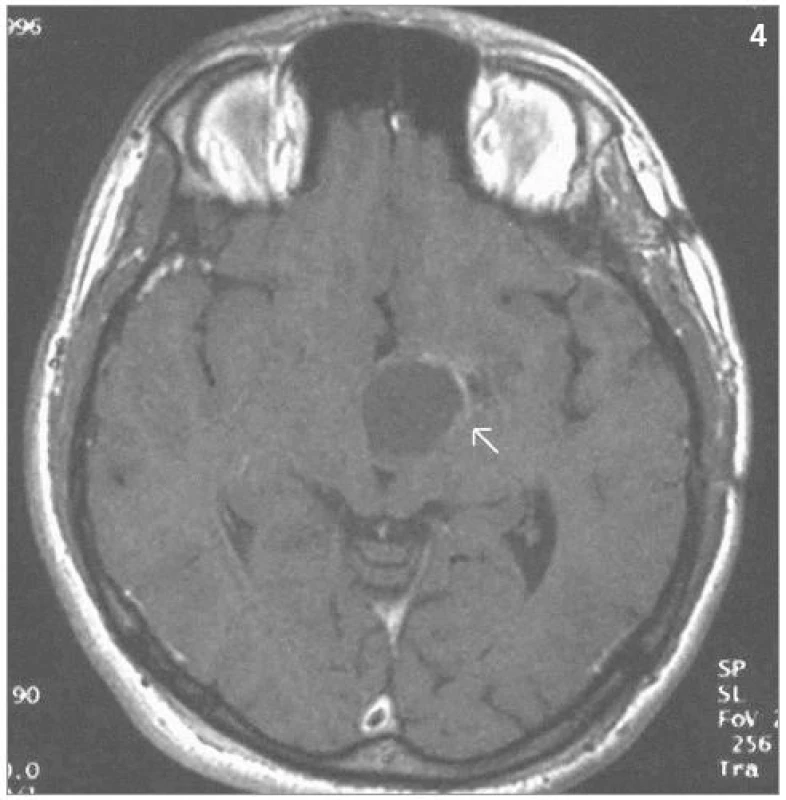 Totéž ložisko 3 roky po ozáření – kontrolní MRI – SE T1-vážený obraz po aplikaci kontrastní látky – patrná progrese cystické složky tumoru spolu se zregredovanou solidní částí tumoru (1996).